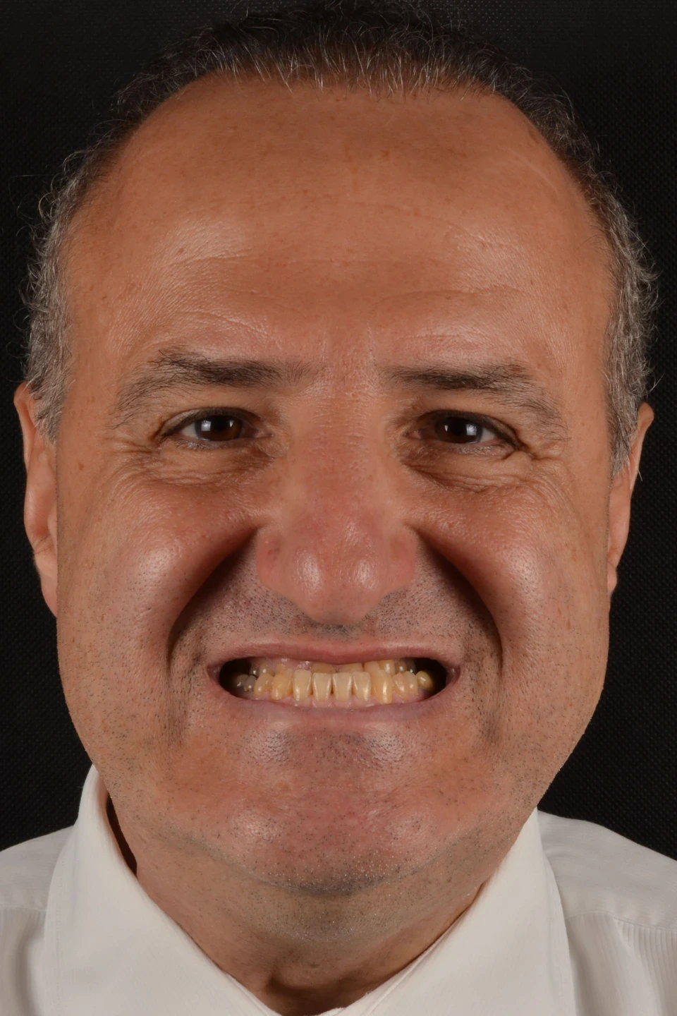 Vista frontal do paciente antes do tratamento com lentes de contato dental