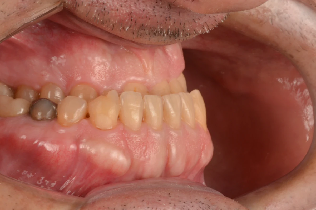 Registro intraoral do lado direito do paciente antes do tratamento com lentes de contato dental