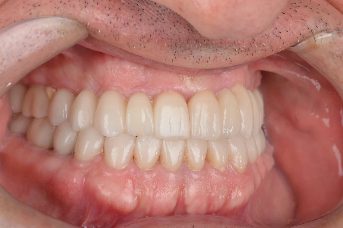 Registro intraoral do lado direito do paciente depois do tratamento com lentes de contato dental