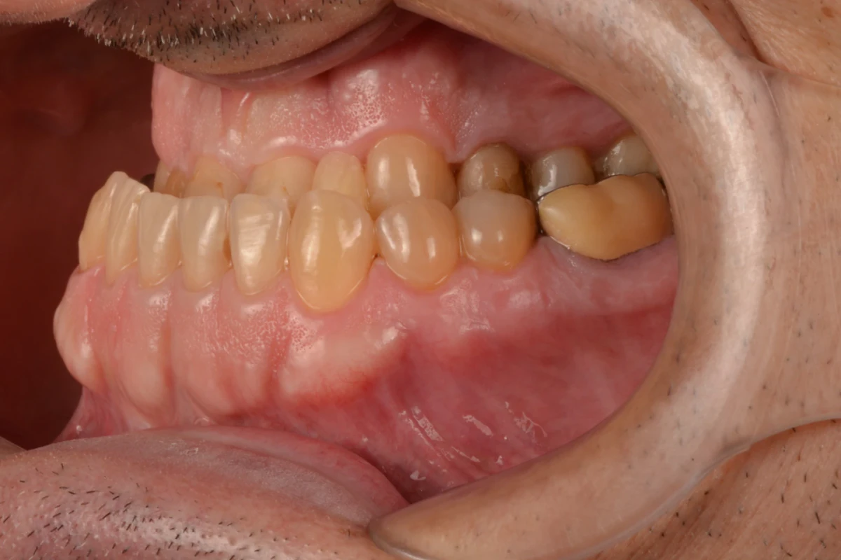 Registro intraoral do lado esquerdo do paciente antes do tratamento com lentes de contato dental