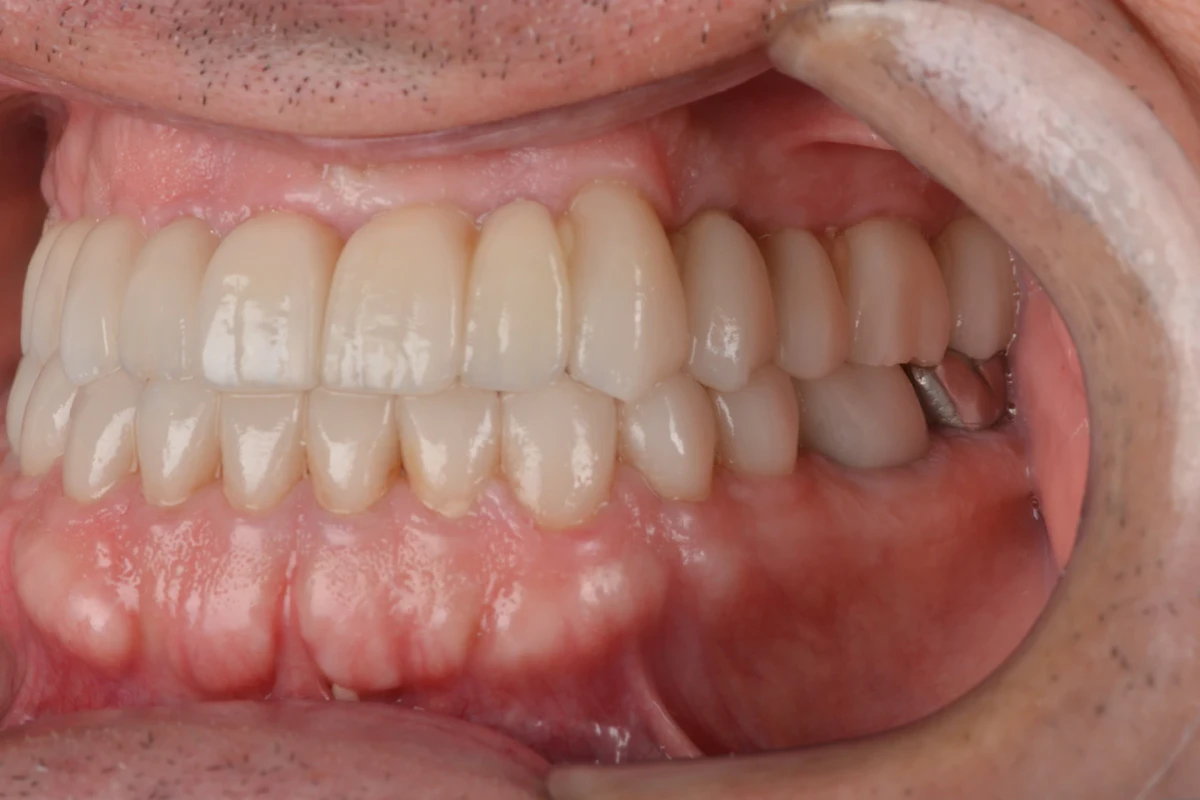 Registro intraoral do lado esquerdo do paciente depois do tratamento com lentes de contato dental