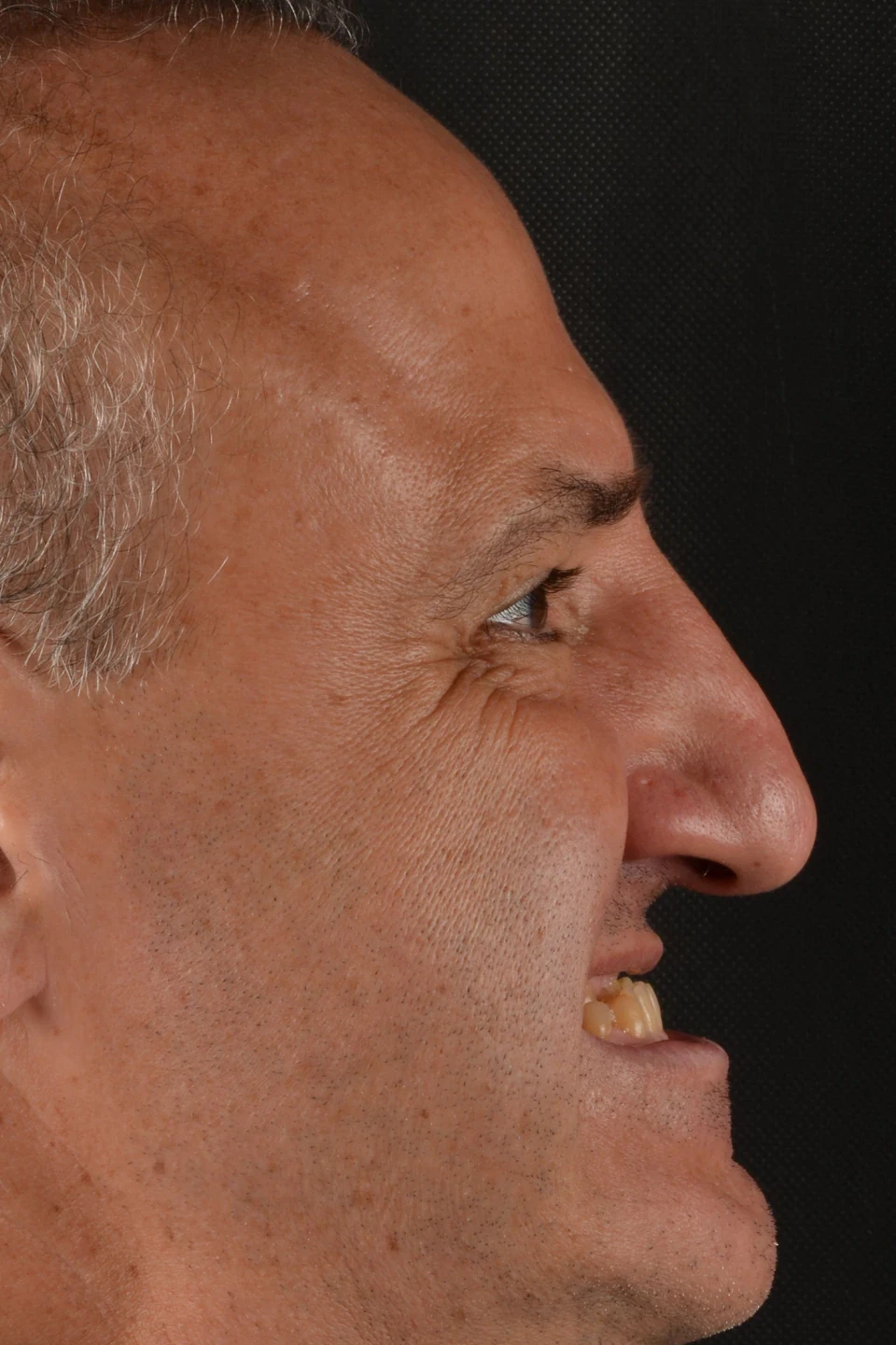 Perfil direito do paciente antes do tratamento com lentes de contato dental