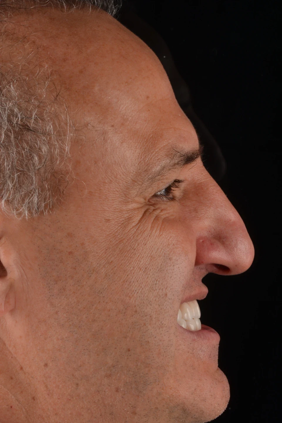 Perfil direito do paciente depois do tratamento com lentes de contato dental