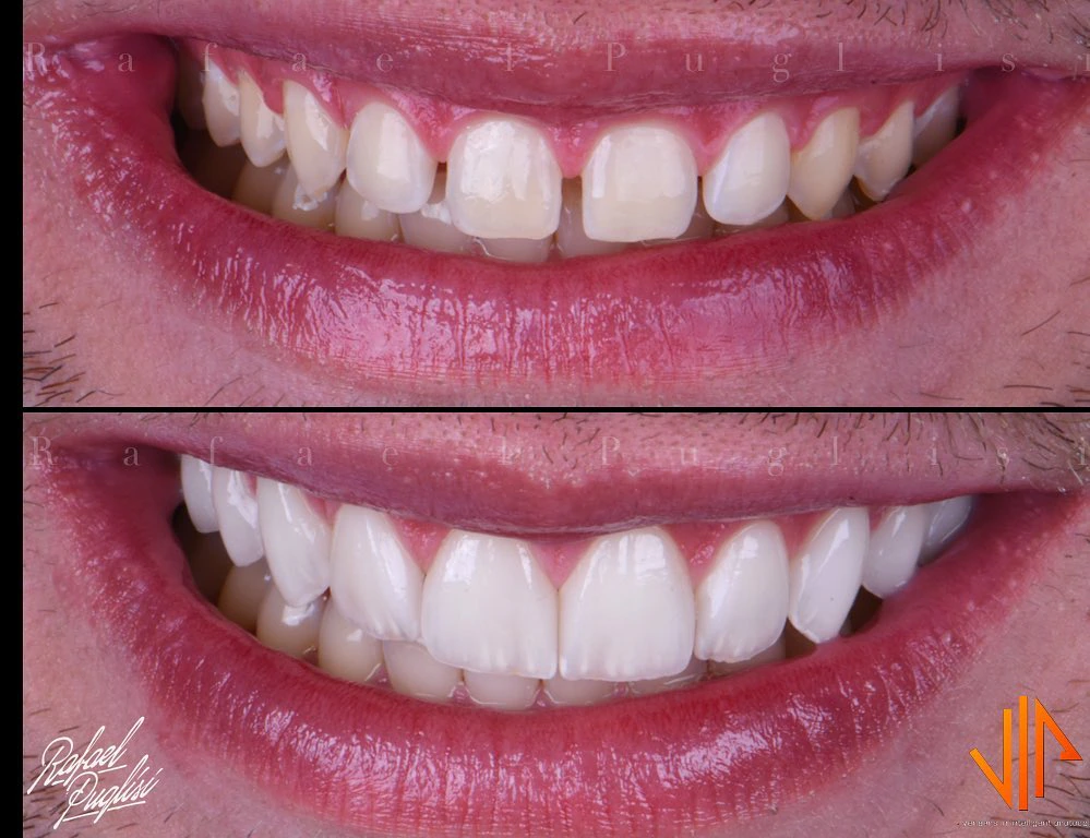 Nova edição da Veneers Intelligent Week: VIW, out/2021 · On-line