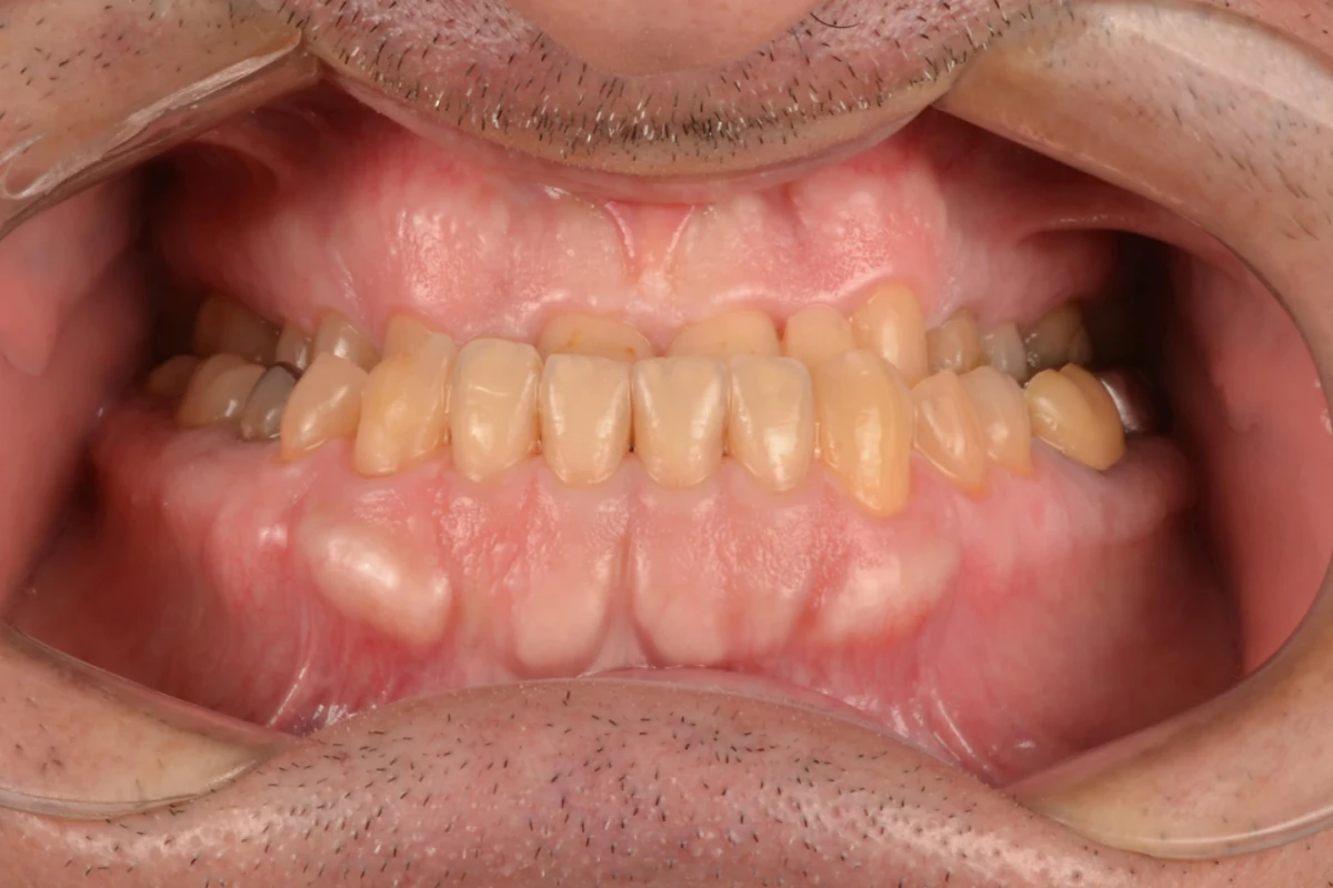 Registro intraoral frontal do paciente antes do tratamento com lentes de contato dental