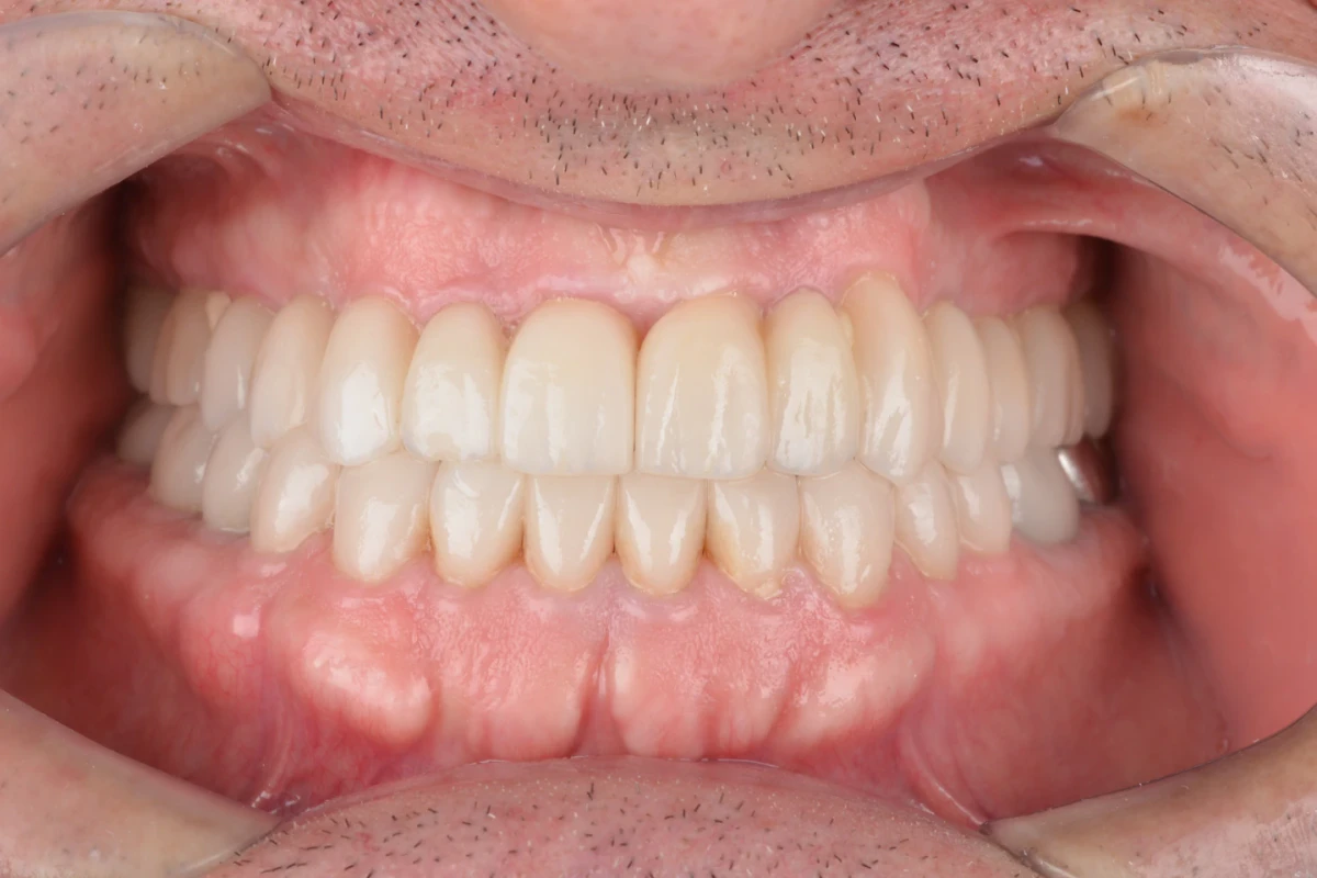 Registro intraoral frontal do paciente depois do tratamento com lentes de contato dental