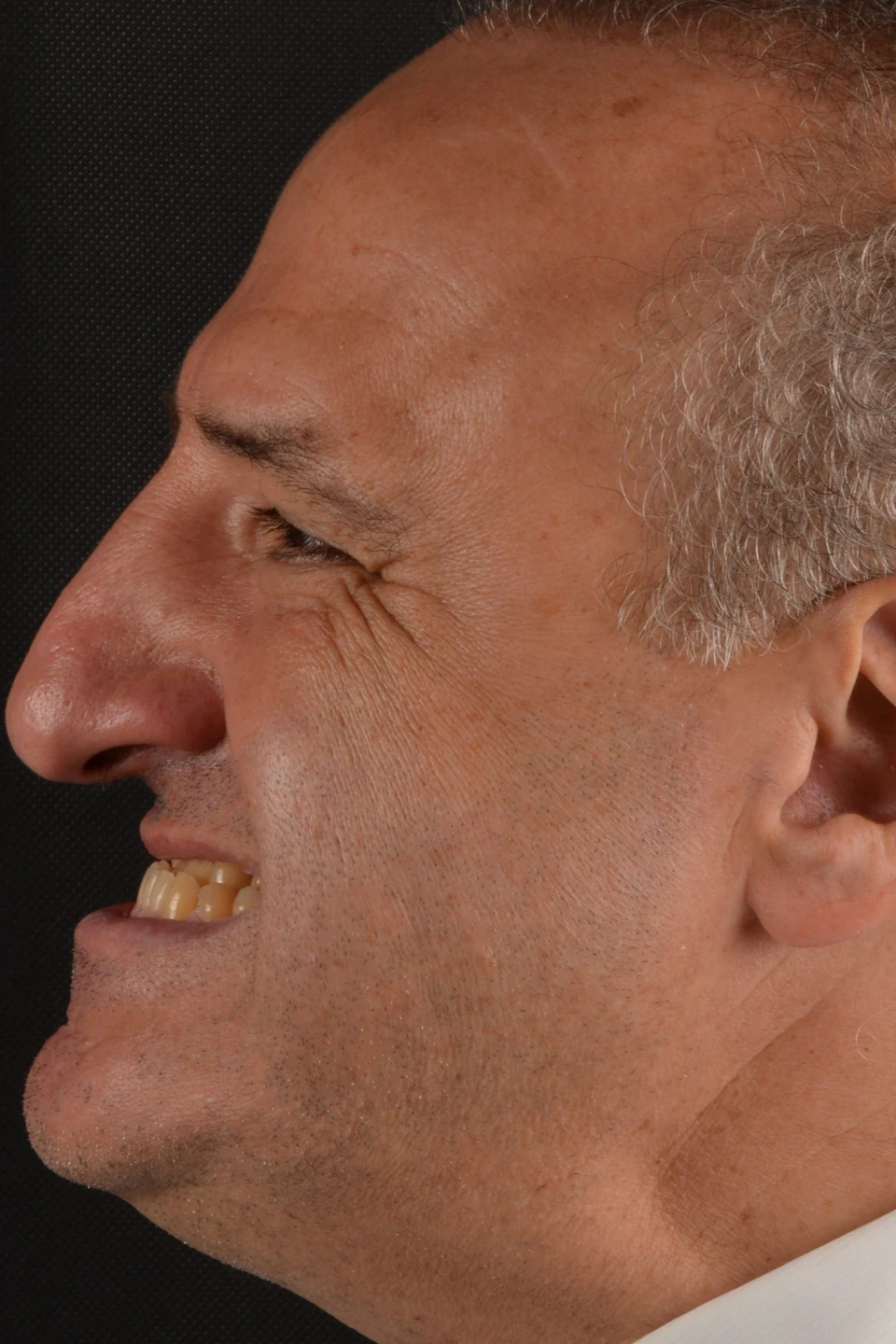 Perfil esquerdo do paciente antes do tratamento com lentes de contato dental