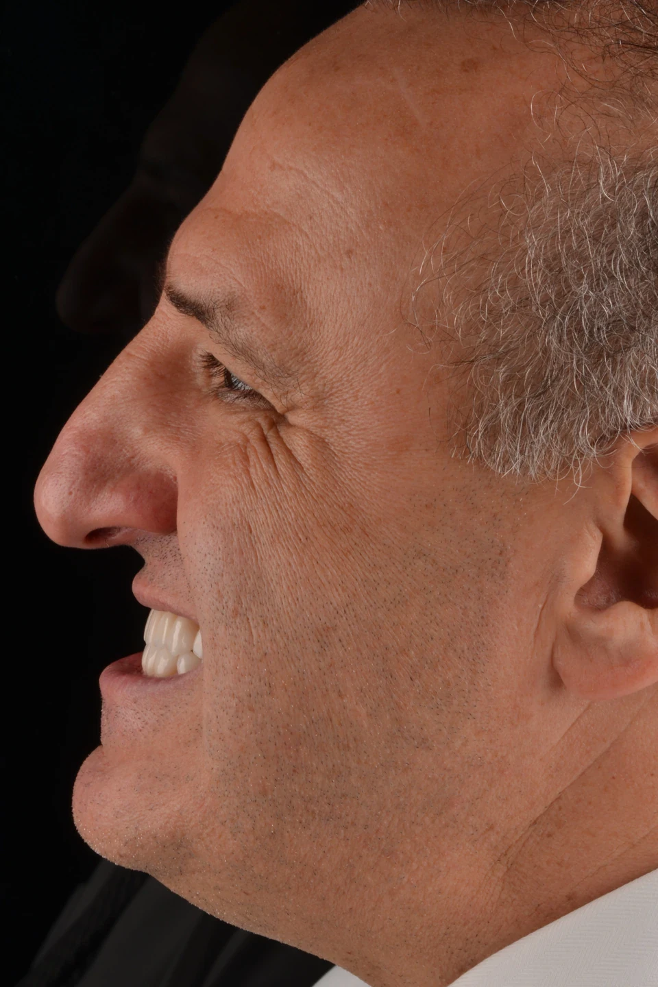 Perfil esquerdo do paciente depois do tratamento com lentes de contato dental