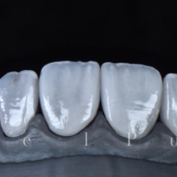 Estudo cerâmico · vista frontal Estudo frontal de forma e textura de peças cerâmicas odontológicas