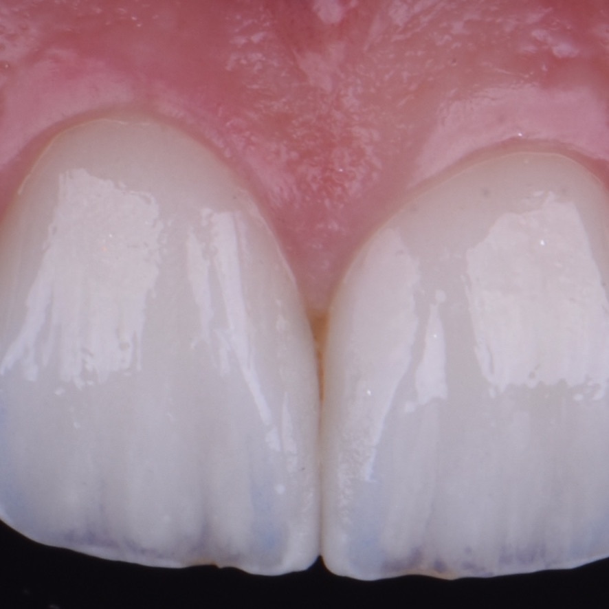 Registro clínico do sorriso · vista frontal Registro clínico frontal dos dentes centrais e da gengiva