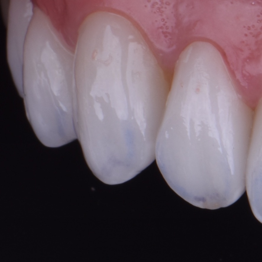Registro clínico do sorriso · vista lateral esquerda Registro clínico do sorriso visto pelo lado esquerdo
