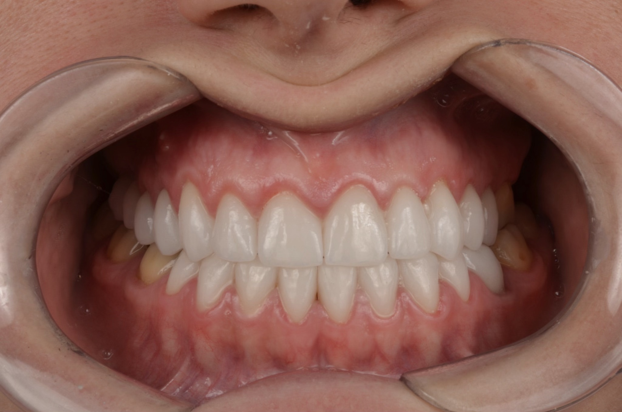 Resultado depois do tratamento com lentes e facetas