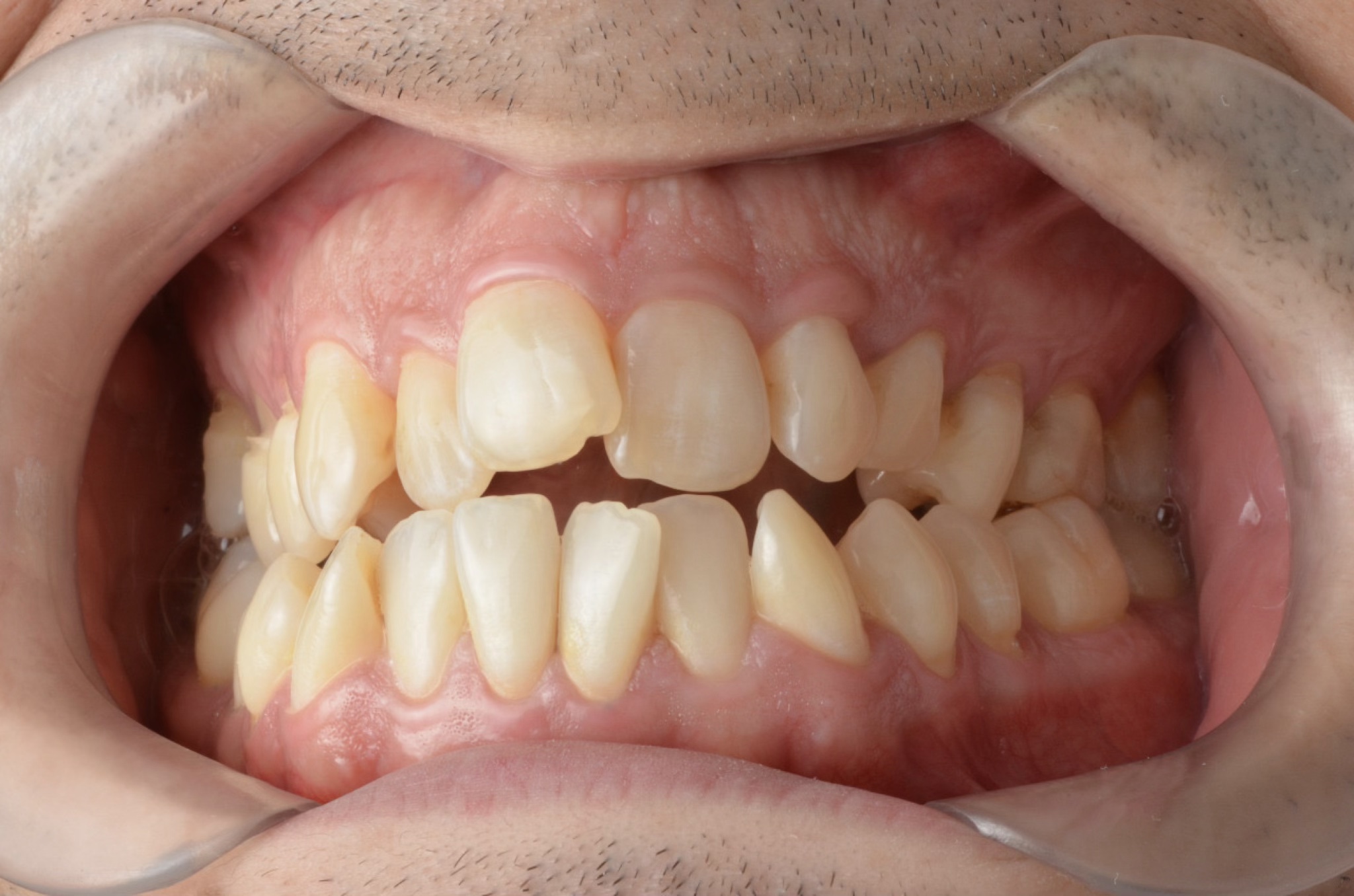 Condição dentária antes do tratamento de reabilitação oral