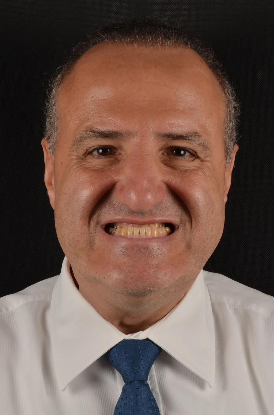 Vista frontal do sorriso do paciente antes do tratamento com lentes de contato dental
