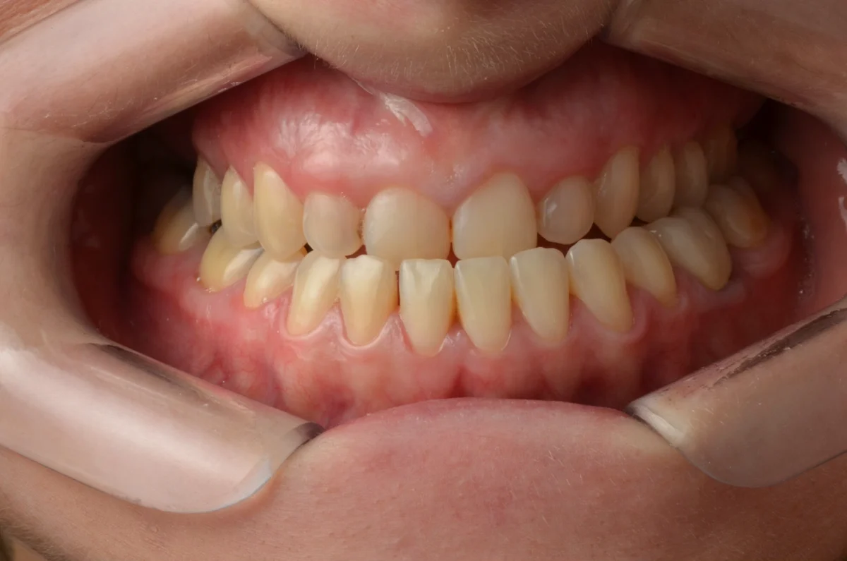 Registro intraoral do paciente antes do tratamento com lentes de contato dental