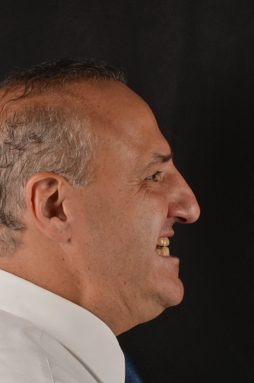 Perfil direito do paciente antes do tratamento com lentes de contato dental