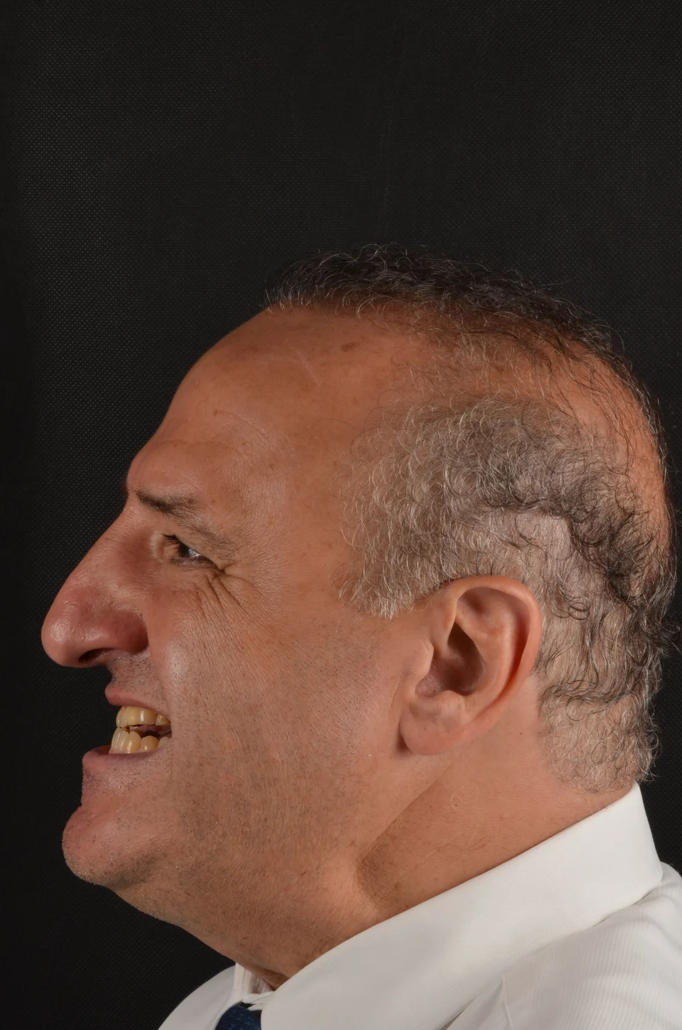 Perfil esquerdo do paciente antes do tratamento com lentes de contato dental
