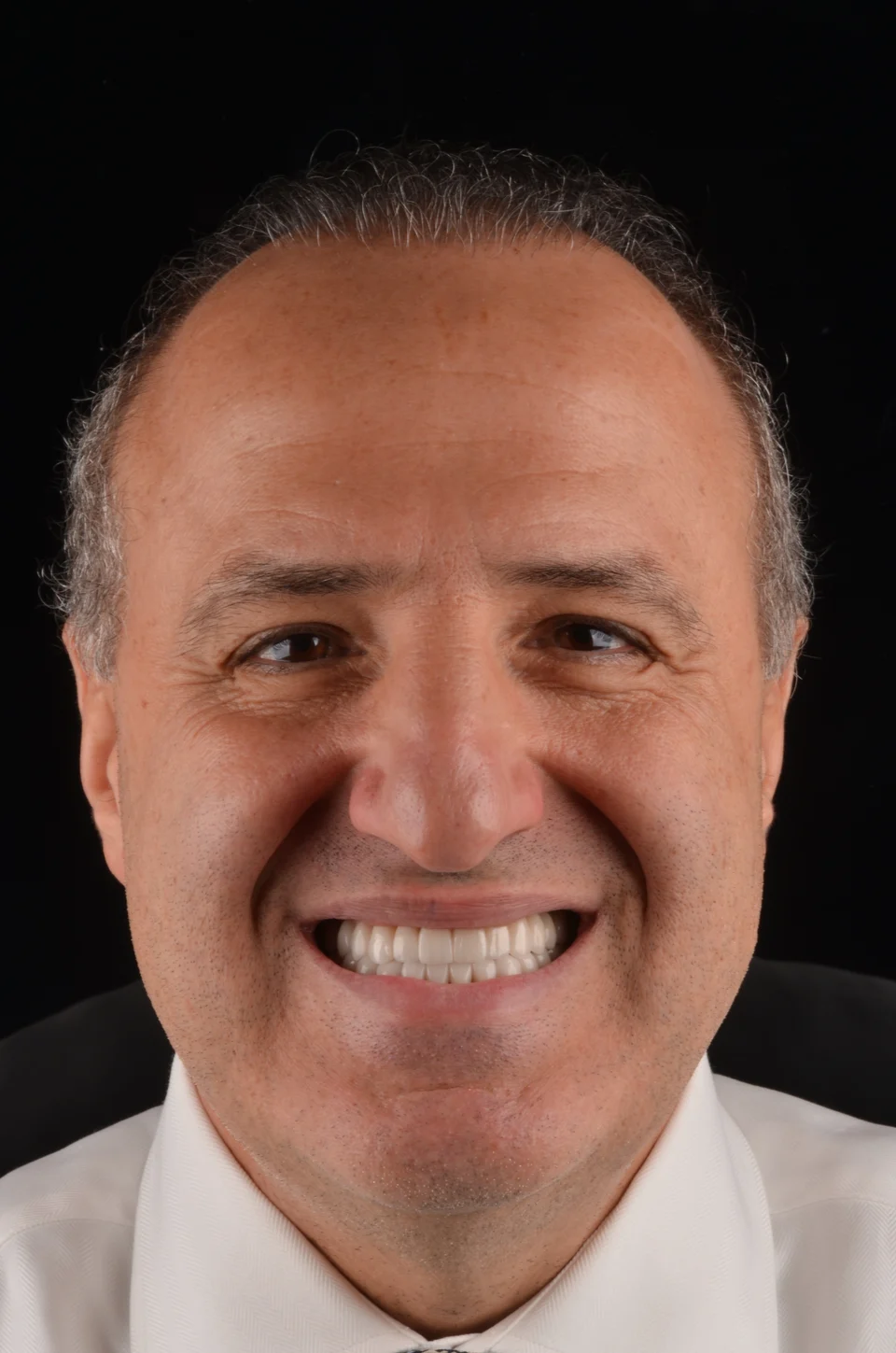 Vista frontal do sorriso do paciente depois do tratamento com lentes de contato dental