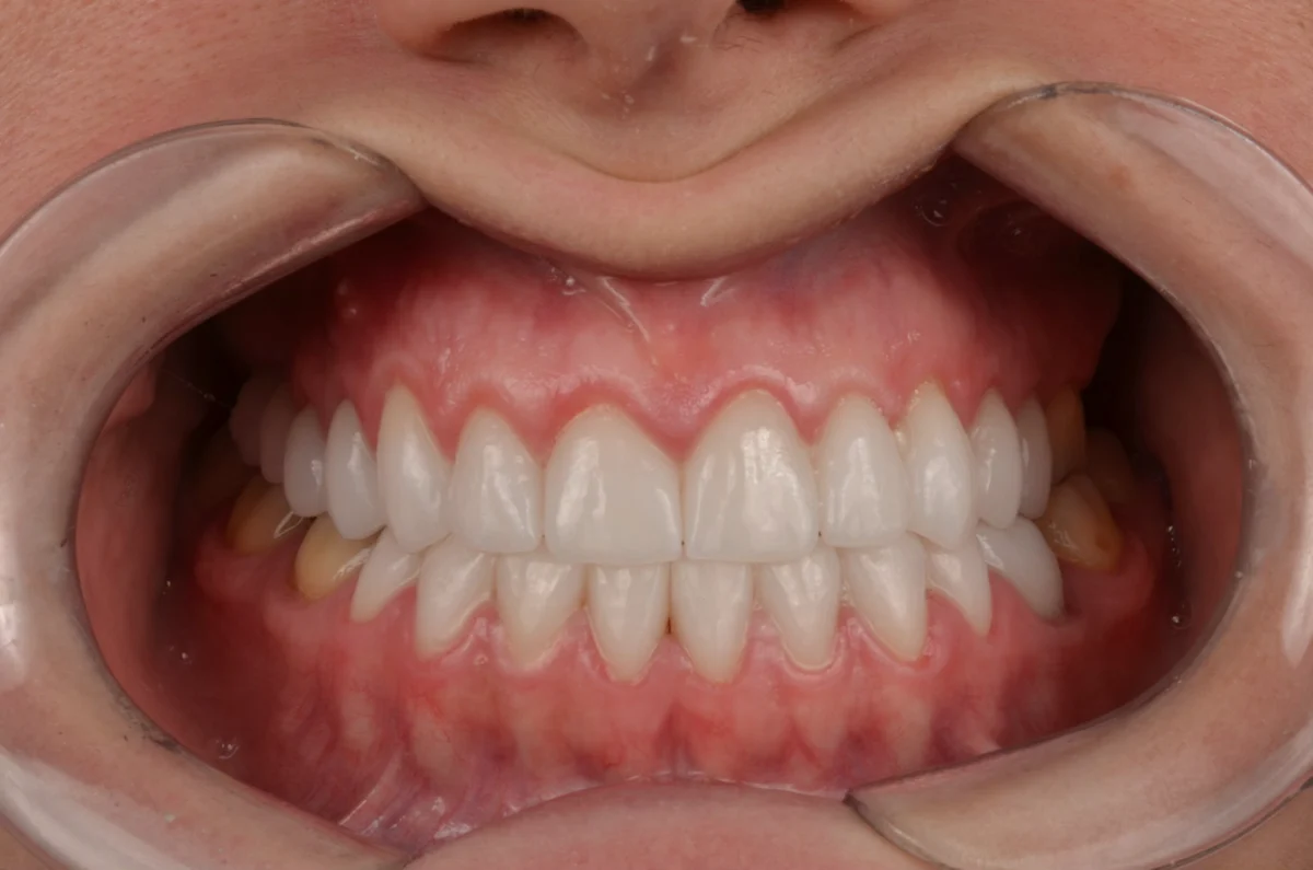 Registro intraoral do paciente depois do tratamento com lentes de contato dental