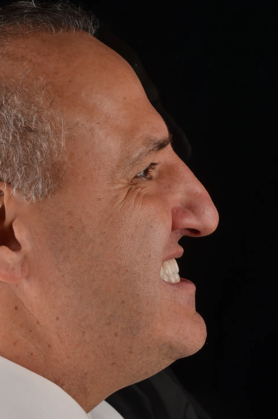 Perfil direito do paciente depois do tratamento com lentes de contato dental