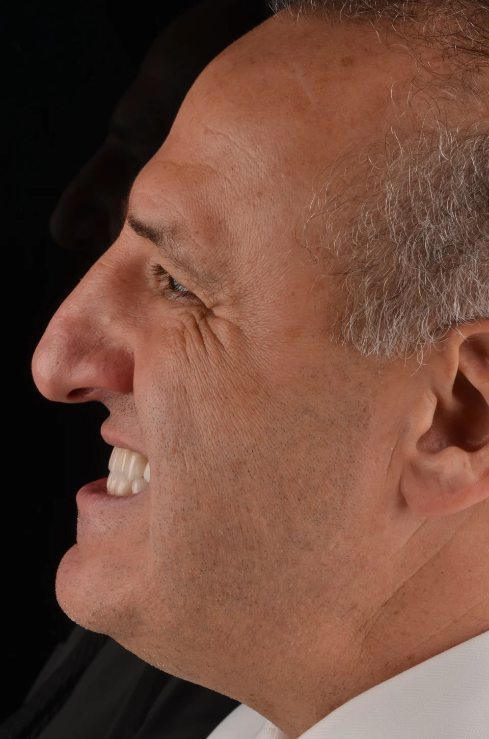 Perfil esquerdo do paciente depois do tratamento com lentes de contato dental