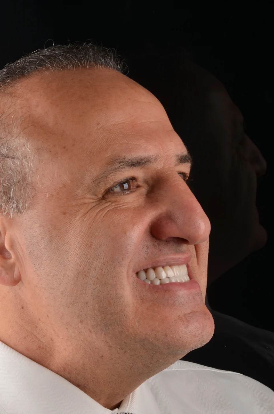 Vista em três quartos do lado direito do paciente depois do tratamento com lentes de contato dental